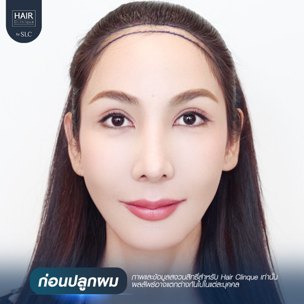 พอร์ช Miss Tiffany’s ปลูกผม, ปลูกผม Long Hair Ready™, มิสทิฟฟานี่, ปรับกรอบหน้า, ปรับกรอบหน้า, หน้าหวานละมุน