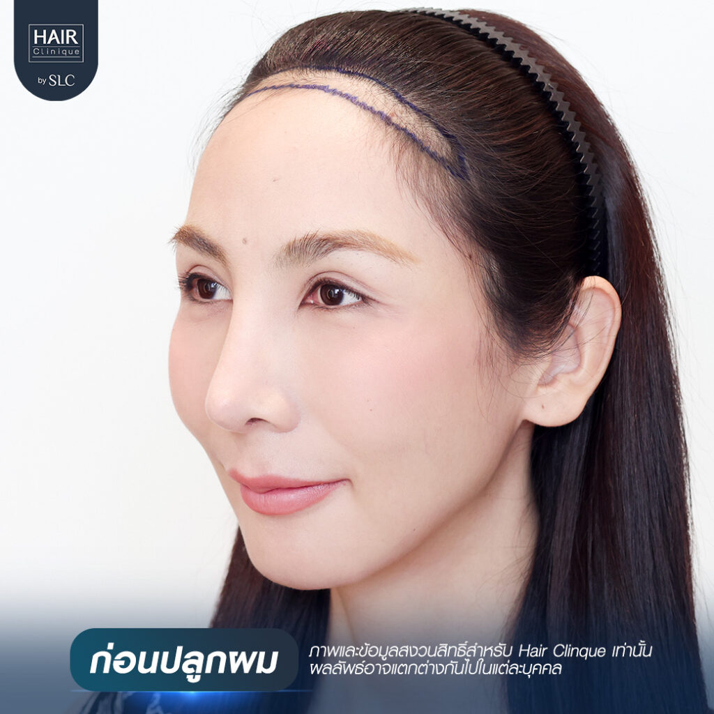 พอร์ช Miss Tiffany’s ปลูกผม, ปลูกผม Long Hair Ready™, มิสทิฟฟานี่, ปรับกรอบหน้า, ปรับกรอบหน้า, หน้าหวานละมุน