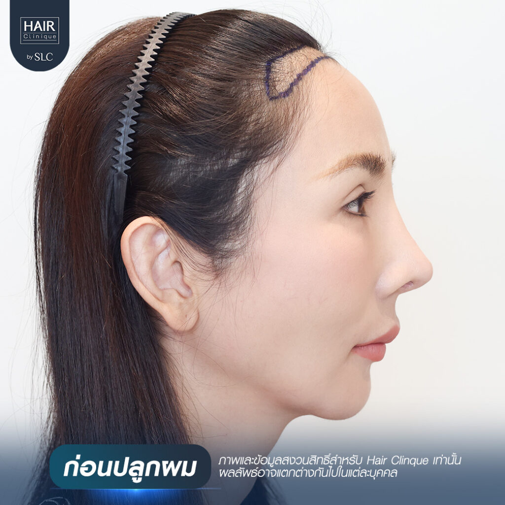 พอร์ช Miss Tiffany’s ปลูกผม, ปลูกผม Long Hair Ready™, มิสทิฟฟานี่, ปรับกรอบหน้า, ปรับกรอบหน้า, หน้าหวานละมุน