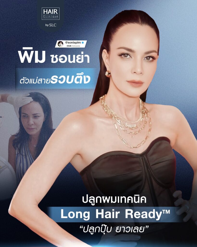 พิม ซอนย่า ปลูกผม, ปลูกผมเทคนิค Long Hair Ready™, ดาราปลูกผมที่ไหน, หัวเถิก, กรอบหน้าชัด