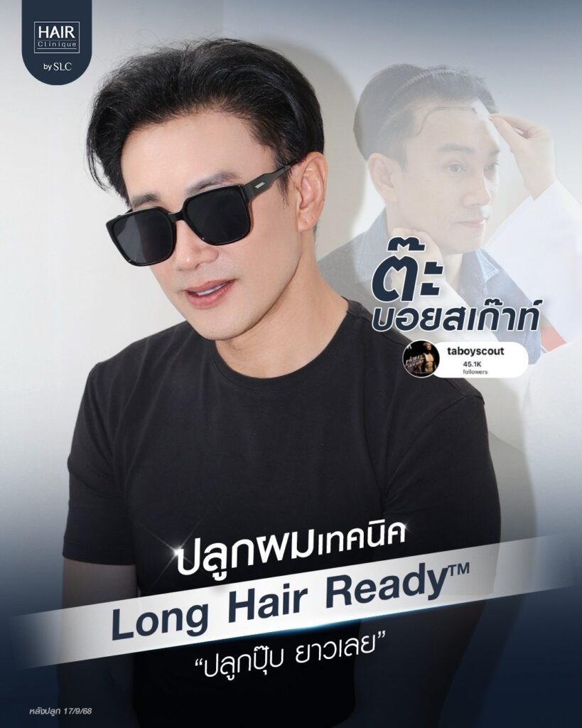 พี่ต๊ะ บอยสเก๊าท์, ดาราปลูกผม, ปลูกผมถาวร, ดาราผมบาง, เทคนิคปลูกผม, ปลูกผมที่ SLC, คนดังปลูกผม