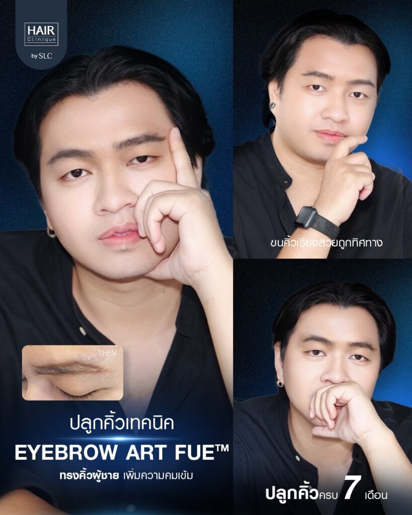 ปลูกคิ้วผู้ชาย, ปลูกคิ้วราคา, ปลูกคิ้วธรรมชาติ, ปลูกคิ้วดีไหม, ปลูกคิ้วที่ไหนดี