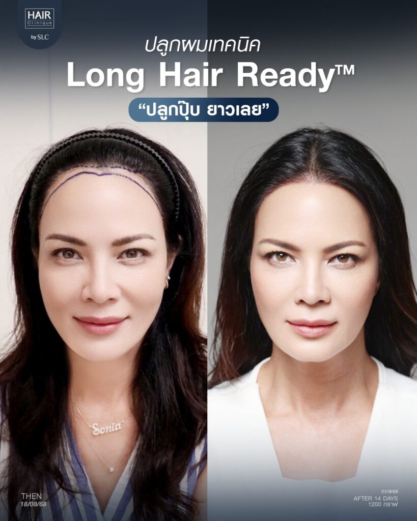 พิม ซอนย่า ปลูกผม, ปลูกผมเทคนิค Long Hair Ready™, ดาราปลูกผมที่ไหน, หัวเถิก, กรอบหน้าชัด