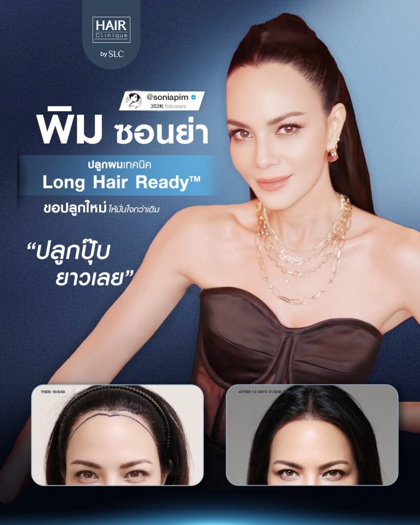 พิม ซอนย่า ปลูกผม, ปลูกผมเทคนิค Long Hair Ready™, ดาราปลูกผมที่ไหน, หัวเถิก, กรอบหน้าชัด