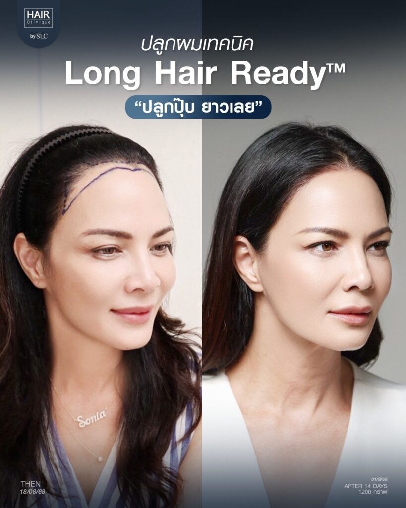 พิม ซอนย่า ปลูกผม, ปลูกผมเทคนิค Long Hair Ready™, ดาราปลูกผมที่ไหน, หัวเถิก, กรอบหน้าชัด