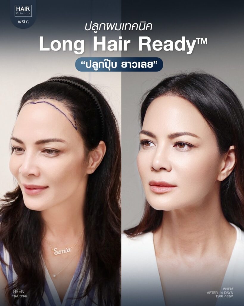 พิม ซอนย่า ปลูกผม, ปลูกผมเทคนิค Long Hair Ready™, ดาราปลูกผมที่ไหน, หัวเถิก, กรอบหน้าชัด