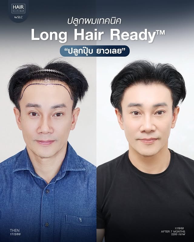 พี่ต๊ะ บอยสเก๊าท์, ดาราปลูกผม, ปลูกผมถาวร, ดาราผมบาง, เทคนิคปลูกผม, ปลูกผมที่ SLC, คนดังปลูกผม